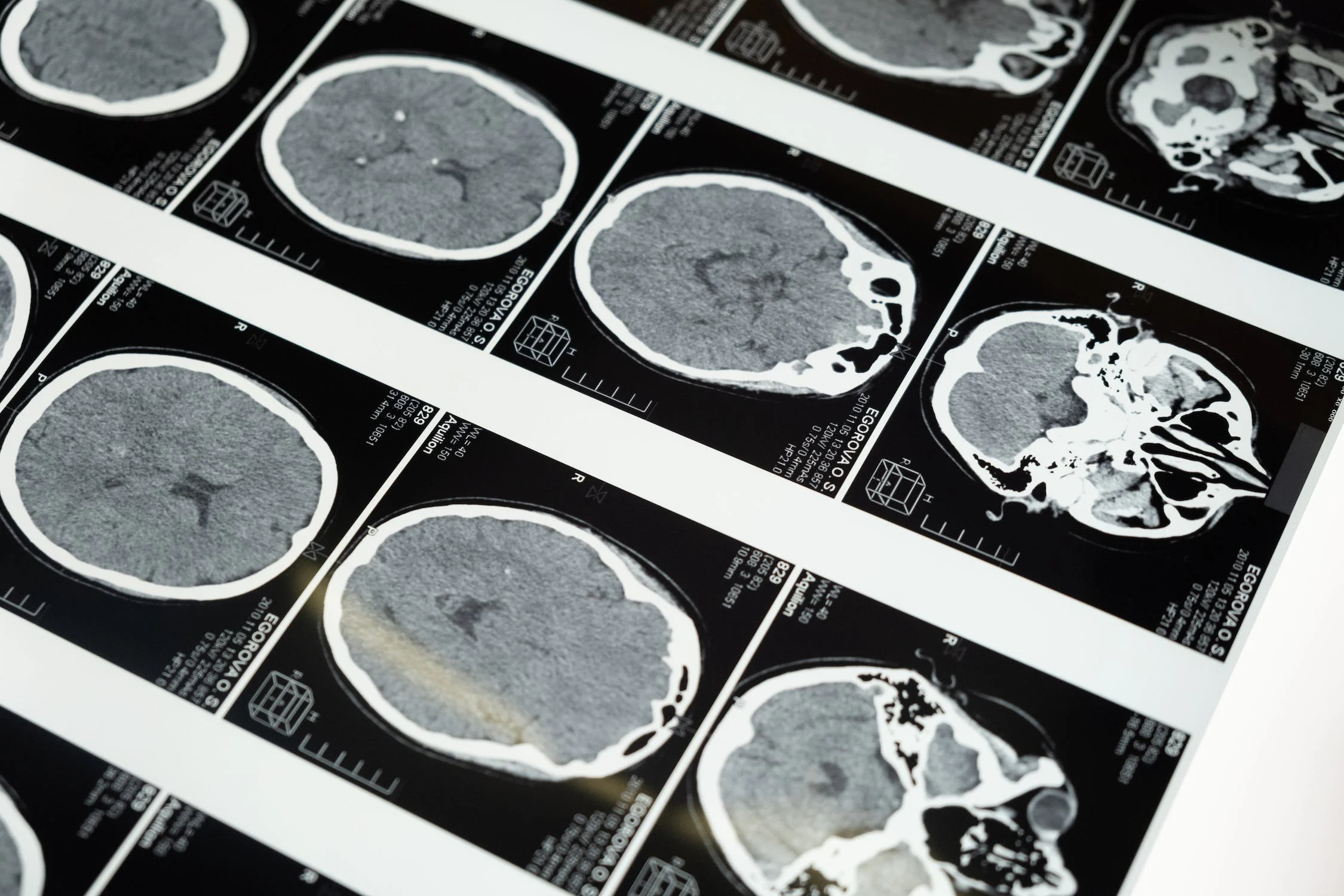 Title: Ultra-Processed Foods Damage the Brain